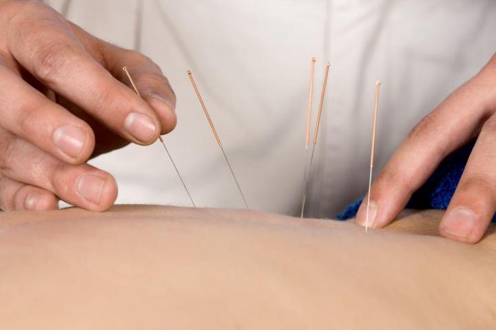 Soins d'acupuncture Les Coteaux